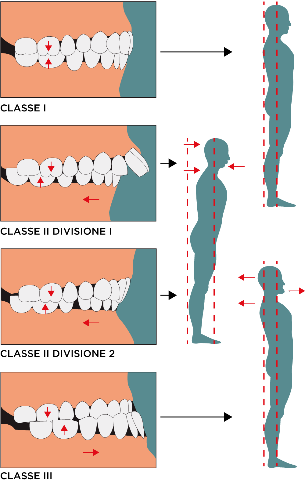 Classi dentali e relative ripercussioni posturali